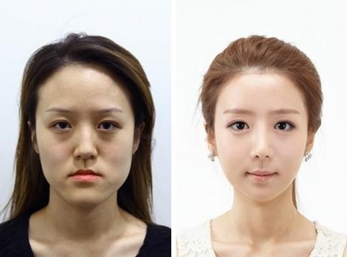 韩国整容节目《let 美人》中嘉宾整容前后的对比照片